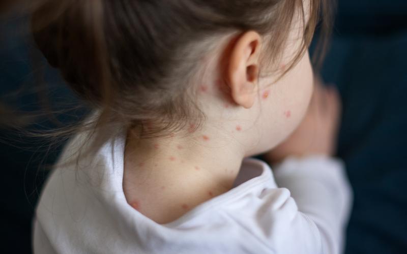 Mässlingsfallen ökar åter i Europa. Det är viktigt att hålla vaccinationsgraden uppe.