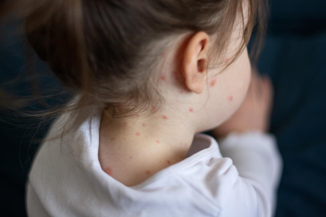 Mässlingsfallen ökar åter i Europa. Det är viktigt att hålla vaccinationsgraden uppe.